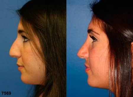 patient-11856-rhinoplasty-nosejob-before-after-5