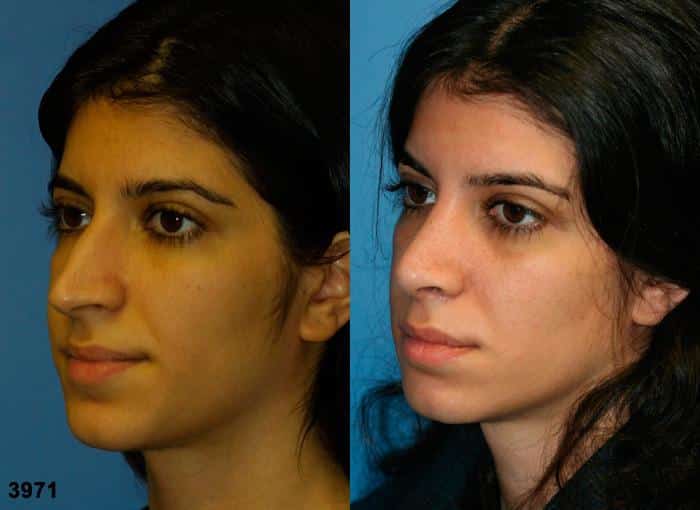 Rhinoplasty to remove dorsal hump and straighten nasal bridge on a female patient by Dr. Miller. Surgery creates more aesthetically pleasing profile, while refining the tip for a more feminine look.