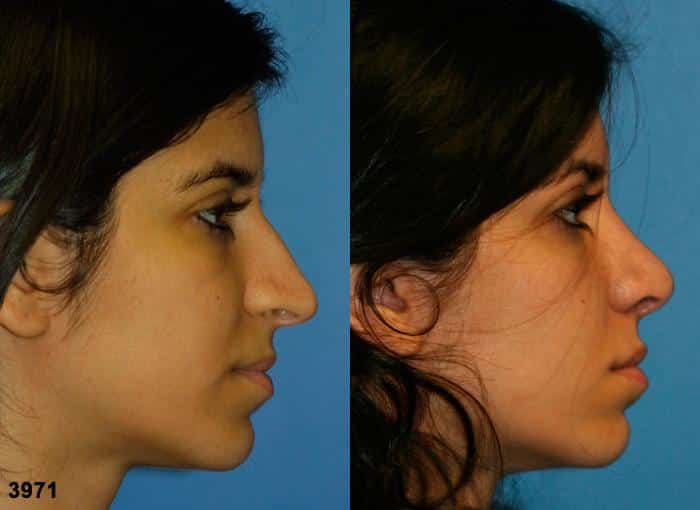 Rhinoplasty to correct nasal bridge and tip of a female patient by Dr. Miller. Surgery creates a more feminine slope to the nose and refines the tip to improve the patient's facial profile.