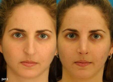 patient-11870-rhinoplasty-nosejob-before-after-3