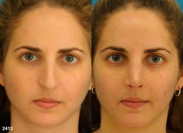 Rhinoplasty to improve nose contour and create symmetry on a female patient by Dr. Miller. After surgery, nose is more balanced and symmetrical, to improve the overall facial contour.