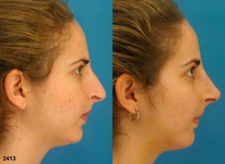 patient-11870-rhinoplasty-nosejob-before-after-4