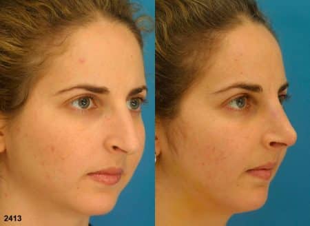 patient-11870-rhinoplasty-nosejob-before-after-5