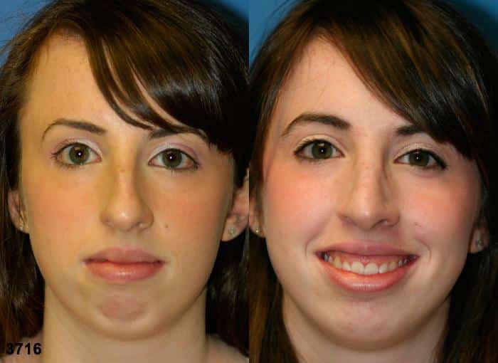Rhinoplasty to remove dorsal hump and straighten nasal bridge on a female patient by Dr. Miller. In addition to creating a better profile, surgery improves the contour of the nose from a front view.