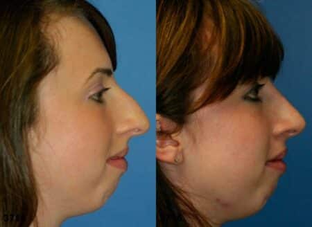 patient-11884-rhinoplasty-nosejob-before-after-5