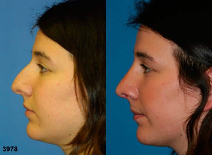 Rhinoplasty to remove dorsal hump and straighten nasal bridge on a female patient by Dr. Miller. Surgery eliminates hump and refines the tip to produce a straighter nose profile.