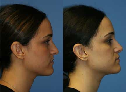 Rhinoplasty to correct nasal bridge and tip of a female patient by Dr. Miller. Surgery creates more aesthetically pleasing slope to the nasal bridge and refines the tip to enhance the patient's facial profile.