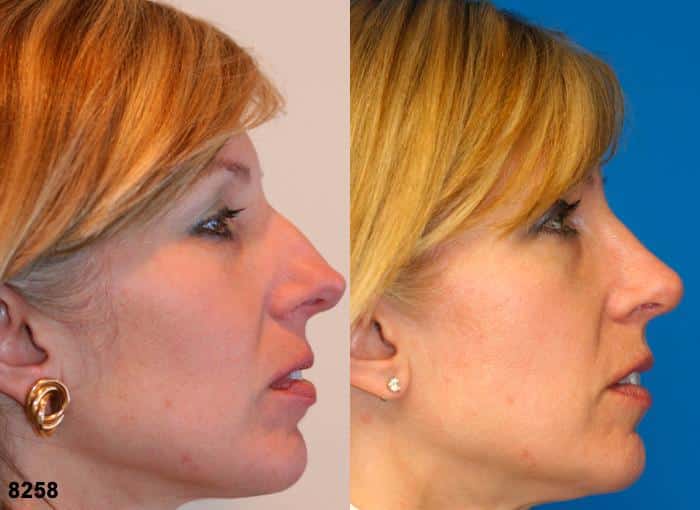 Rhinoplasty to remove dorsal hump and straighten nasal bridge on a female patient by Dr. Miller. In addition to eliminating the bump, surgery refines the nasal tip to create a more aesthetically pleasing facial profile.