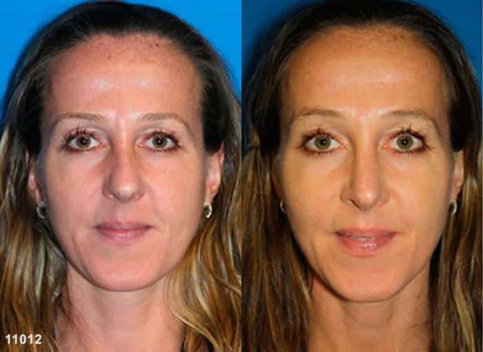 Rhinoplasty to remove dorsal hump and straighten nasal bridge on a female patient by Dr. Miller. Surgery improves shape of nose to bring facial features into balance.
