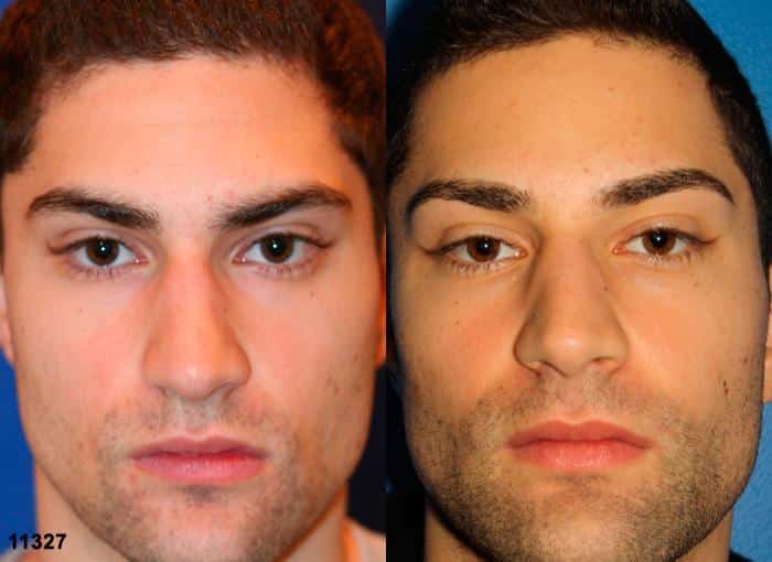 Rhinoplasty to strengthen nasal bridge of a male patient by Dr. Miller. Surgery creates nose shape and size that is more proportionate to patient's other facial features.