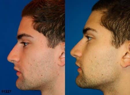 patient-11913-rhinoplasty-nosejob-before-after-5