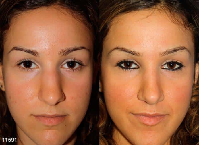 Rhinoplasty to remove dorsal hump and straighten nasal bridge on a female patient by Dr. Miller. Surgery improves nose shape from both the front and side views.