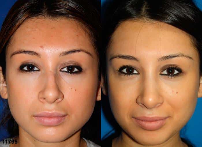 Rhinoplasty to straighten and strengthen the nasal bridge of a female patient by Dr. Miller. Surgery creates a more aesthetically pleasing, proportionate facial contour.
