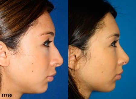 patient-11925-rhinoplasty-nosejob-before-after-5