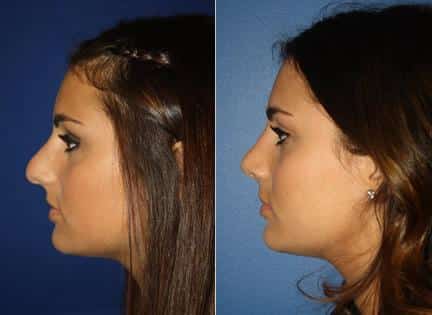 patient-11932-rhinoplasty-nosejob-before-after-1