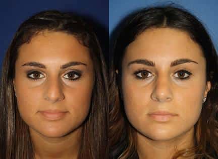 Rhinoplasty to improve nasal bridge and tip of a female patient by Dr. Miller. Surgery creates a more proportionate, balanced feature and a more attractive facial contour.
