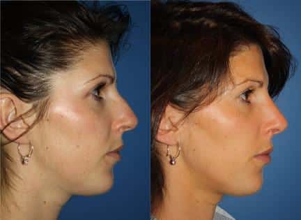 patient-11937-rhinoplasty-nosejob-before-after-1
