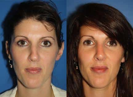 Rhinoplasty to straighten nasal bridge of a female patient by Dr. Miller. Surgery enhances nose shape to create symmetry and balance in the facial contour.