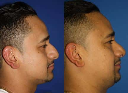 male mexican nose job on a patient from new york city