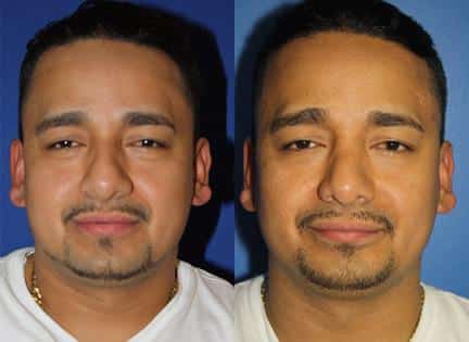 Rhinoplasty to correct nasal bridge and improve nose shape of a male patient by Dr. Miller. Nose is more balanced and proportionate after surgery.