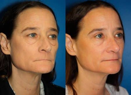 patient-11947-rhinoplasty-nosejob-before-after-1