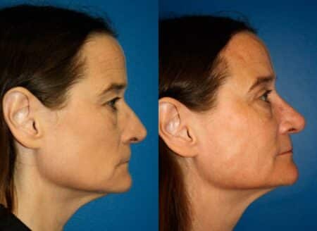 patient-11947-rhinoplasty-nosejob-before-after-2