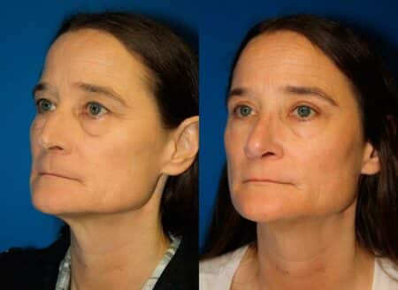 patient-11947-rhinoplasty-nosejob-before-after-3