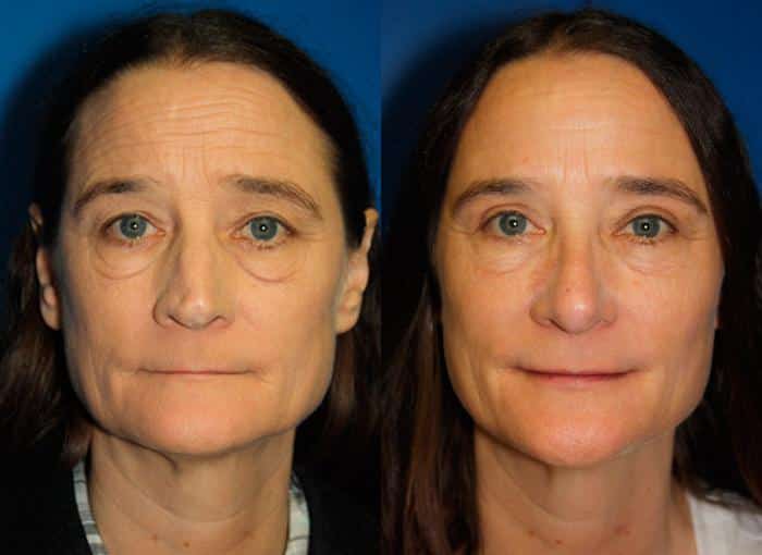 Rhinoplasty to straighten nasal bridge of a female patient by Dr. Miller. Surgery creates symmetry and proportion in the facial contour.
