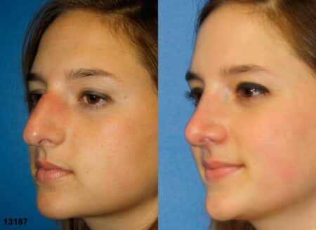 patient-11956-rhinoplasty-nosejob-before-after-1