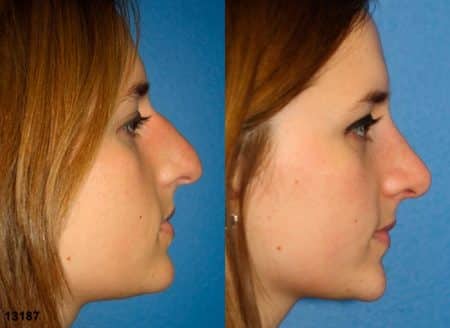 patient-11956-rhinoplasty-nosejob-before-after-2