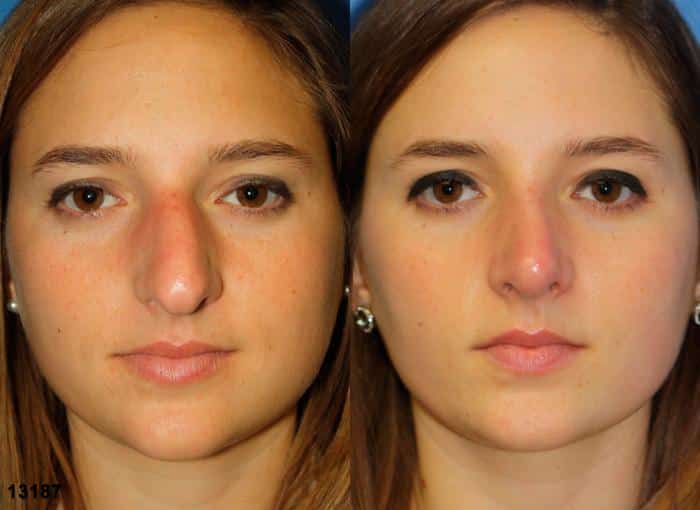 Rhinoplasty to correct nasal bridge and tip of a female patient by Dr. Miller. After surgery, bridge is refined and nasal tip is slightly rotated to improve facial contour.