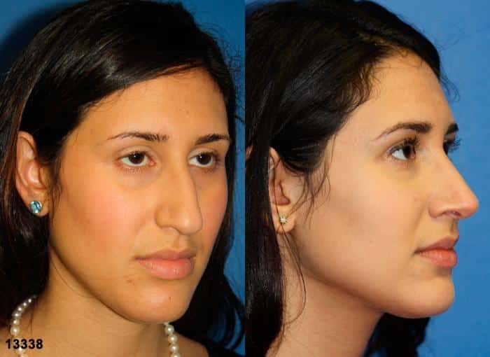 middle eastern rhinoplasty results