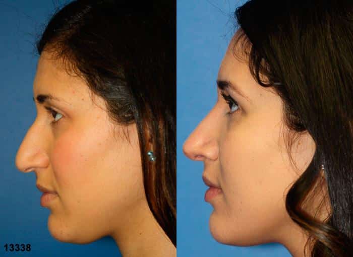 Rhinoplasty to straighten nasal bridge and refine the tip of a female patient by Dr. Miller. Surgery creates straighter nasal bridge with rotated tip that improves the patient's facial profile.