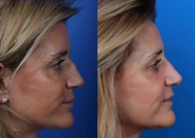 Rhinoplasty to remove a bump from the nasal bridge and enhance the facial profile of a female patient by Dr. Miller. Surgery straightens nasal bridge and slightly rotates tip to improve nose shape and profile.