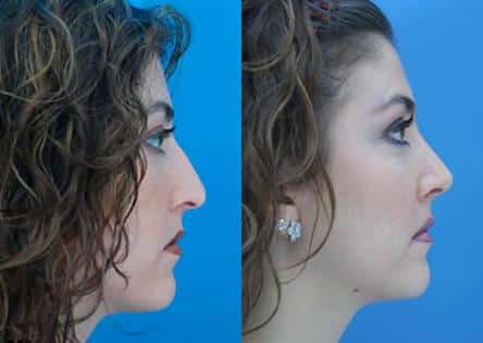 Rhinoplasty to correct nasal bridge and tip of a female patient by Dr. Miller. After surgery, bridge is straighter and tip is rotated to improve the patient's facial profile.