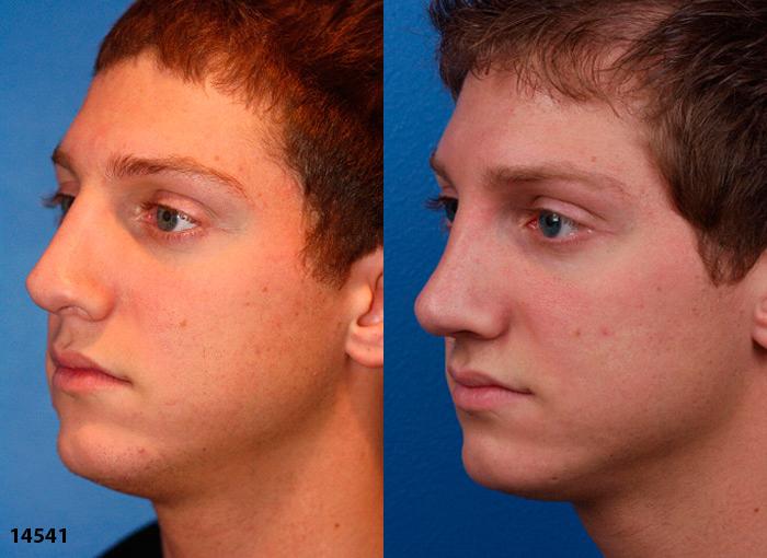 Revision rhinoplasty to correct nasal bridge and improve facial profile of a male patient by Dr. Miller. After surgery, nasal bridge is straighter and tip is slightly refined for an improved shape and profile.