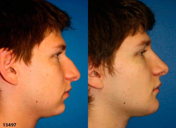 Rhinoplasty to correct nasal bridge of a male patient by Dr. Miller. Patient's profile is improved after surgery with straighter nasal bridge and refined tip.