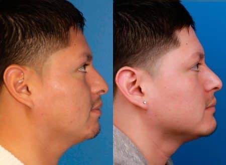 patient-12009-rhinoplasty-nosejob-before-after-1