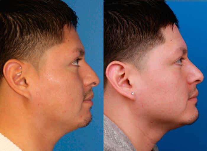Rhinoplasty to straighten nasal bridge and implant to strengthen the chin of a male patient by Dr. Miller. Procedure produces straighter bridge and stronger chin to improve patient's facial profile.