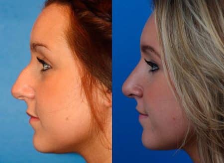 patient-12012-rhinoplasty-nosejob-before-after-3