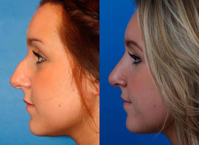 Rhinoplasty to remove dorsal hump and straighten nasal bridge on a female patient by Dr. Miller. Surgery creates improved profile with straighter bridge and rotated, refined tip.