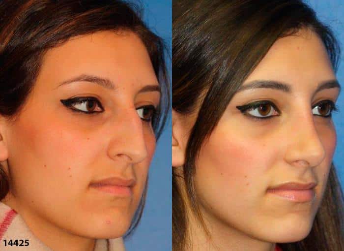 Rhinoplasty to remove a bump from the nasal bridge and refine the tip of a female patient by Dr. Miller. Straighter bridge and enhanced tip produce an improved facial contour.