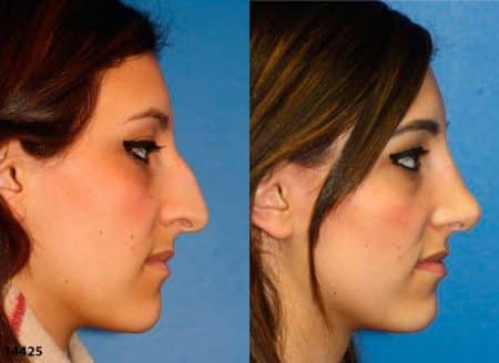 patient-12017-rhinoplasty-nosejob-before-after-7