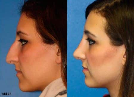 patient-12017-rhinoplasty-nosejob-before-after-8