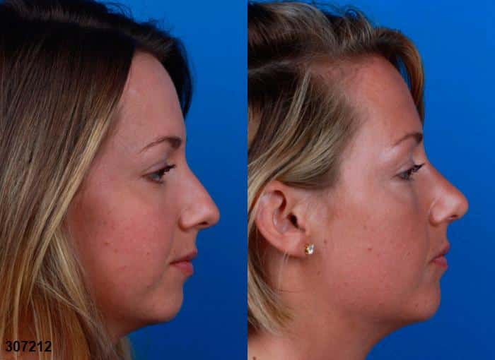 Rhinoplasty to refine the nasal bridge and tip on a female patient by Dr. Miller. After surgery, bridge has more attractive slope and nasal tip is slightly rotated for an improved facial profile.