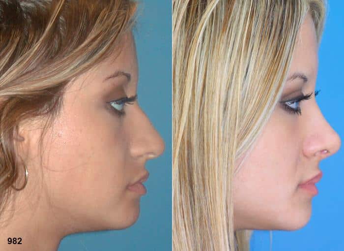 Rhinoplasty to refine the nasal bridge and tip on a female patient by Dr. Miller. Surgery creates more feminine slope to nasal bridge and rotates the tip to improve the facial contour.