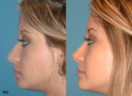 patient-12040-rhinoplasty-nosejob-before-after-3