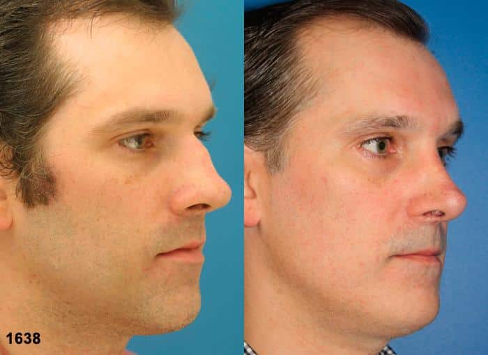 Rhinoplasty to remove a bump from the nasal bridge of a male patient by Dr. Miller. After surgery, bump is gone and bridge is straighter to improve the facial profile.