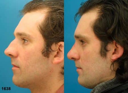 patient-12045-rhinoplasty-nosejob-before-after-3