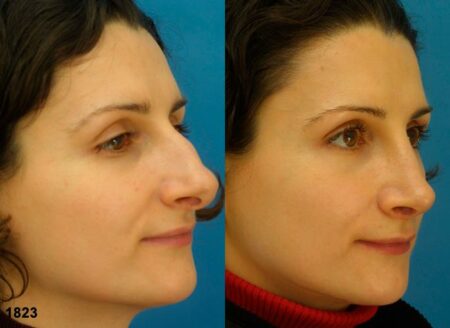 patient-12050-rhinoplasty-nosejob-before-after-1